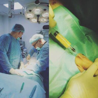Penis thickening is possible with the help of surgery