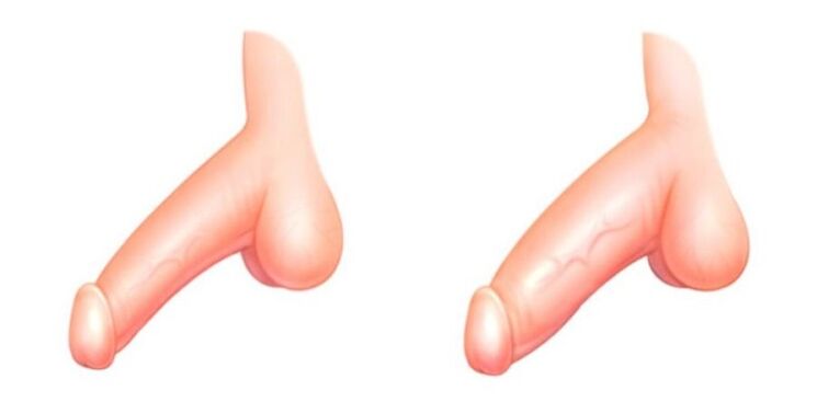 Penis enlargement before and after